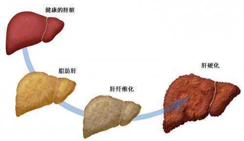 脂肪肝对志愿报考（脂肪肝影响报考大学吗）