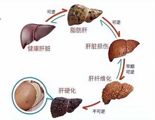 脂肪肝对志愿报考（脂肪肝影响报考大学吗）